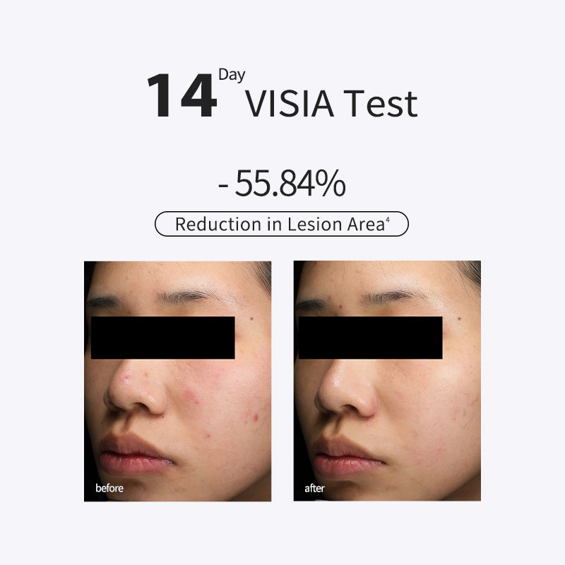 15% Azelaic Acid Purifying Lotion