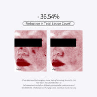 15% Azelaic Acid Purifying Lotion