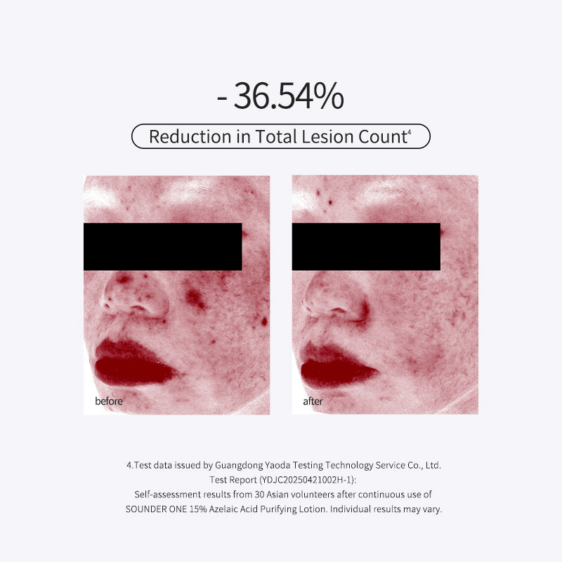 15% Azelaic Acid Purifying Lotion